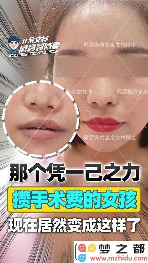守护兔唇宝宝灿烂笑容所需的无尽爱心-手术背后温暖堆砌的力量